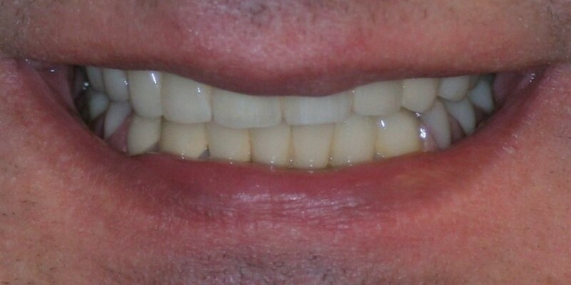 rekonstrukcja zębów warszawa