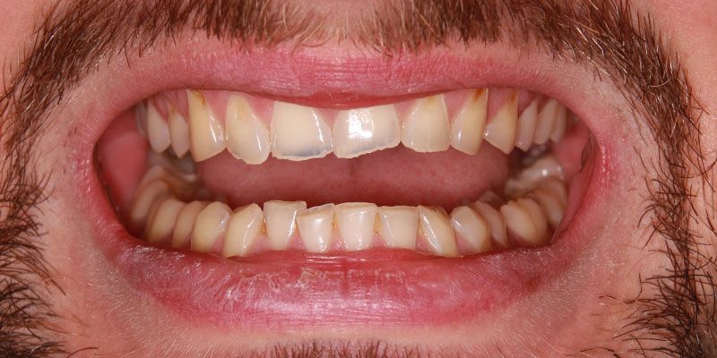 podwyższenie wysokości zwarcia zębów