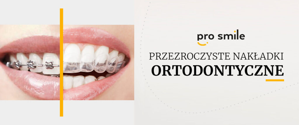 nakładki ortodontyczne warszawa
