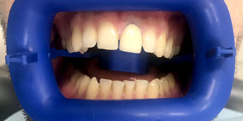 odbudowa złamanego zęba