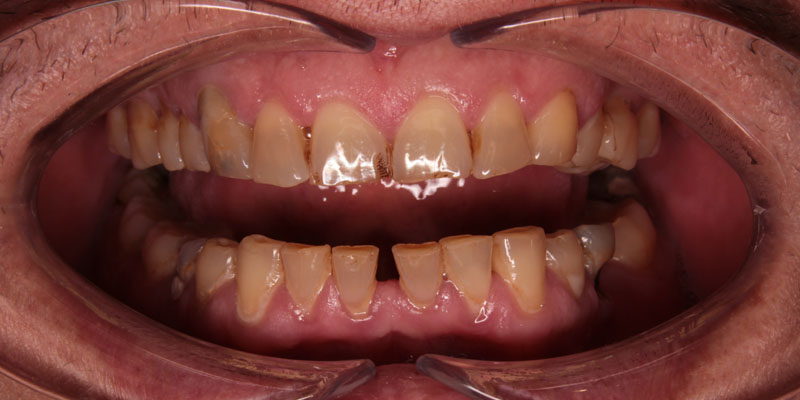nadbudowa startych zębów warszawa
