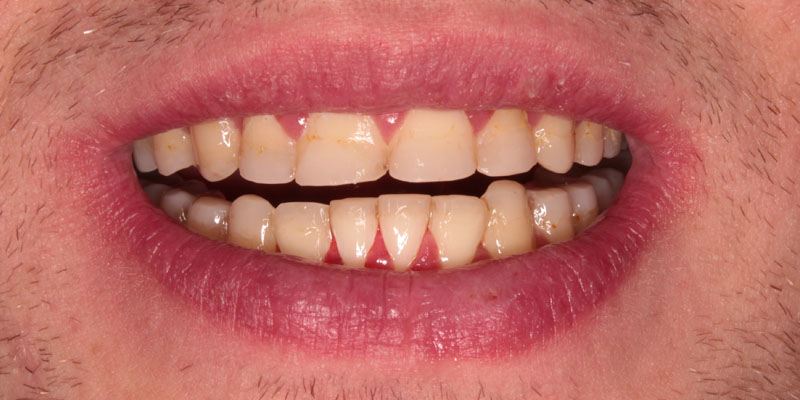 rekonstrukcja zwarcia zębów