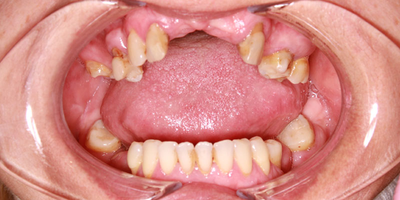 uzupełnienie braków zębowych