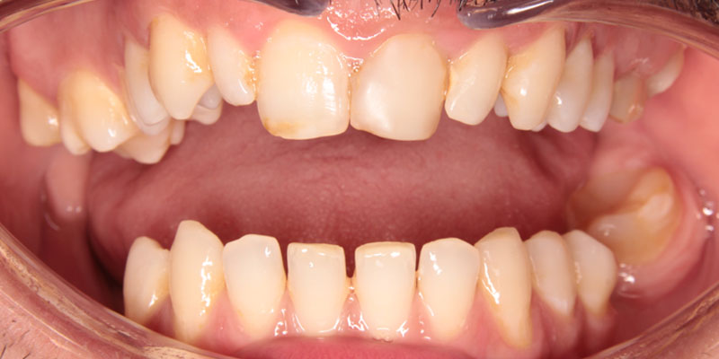 prostowanie krzywych zębów