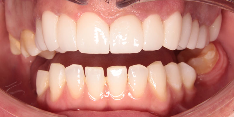 rekonstrukcja zębów warszawa