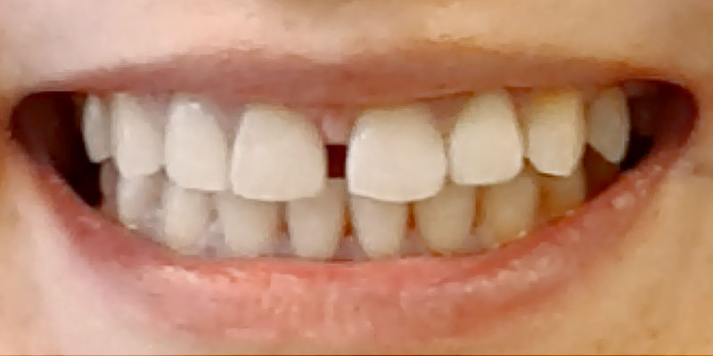 podniesienie wysokości zwarcia zębów