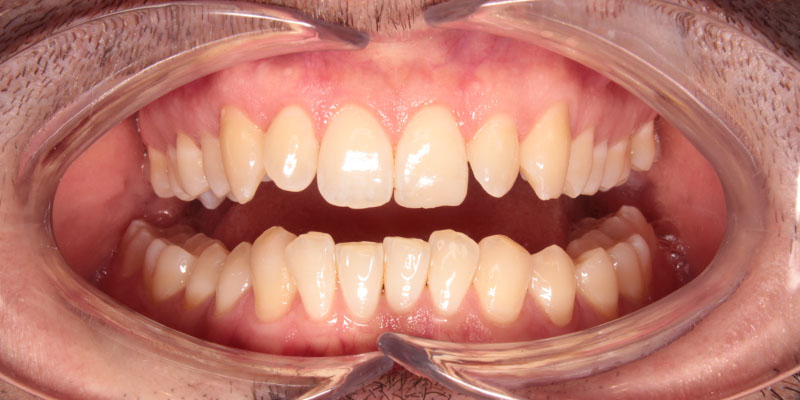 leczenie ortodontyczne przezroczystymi nakładkami