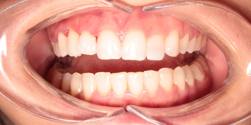odbudowa kształtu zębów licówką