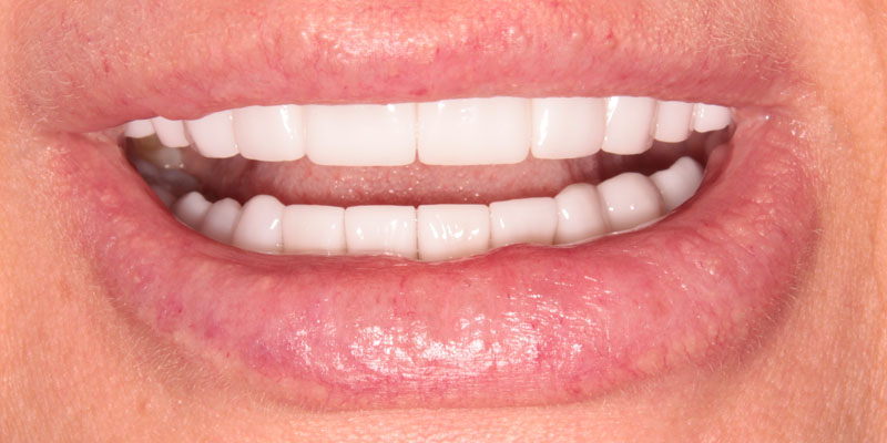 usunięcie przerwy między zębami