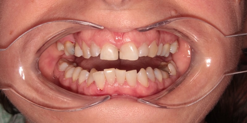Uzupełnienie protetyczne zębów przed