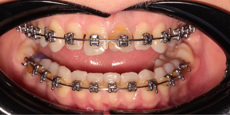 aparat ortodontyczny przed założeniem licówek