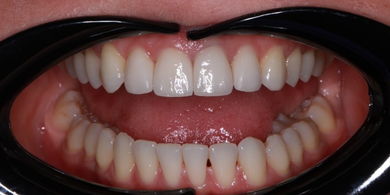 licówki po leczeniu ortodontycznym