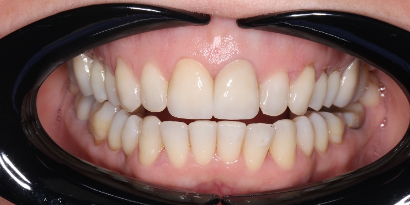 leczenie stomatologiczne z poprawą wyglądu zębów po