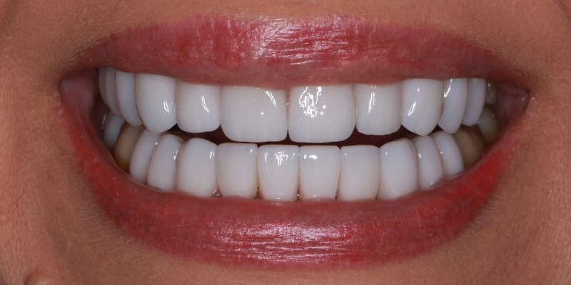 licówki na zęby po