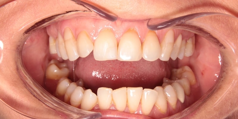 licówki na zęby przed