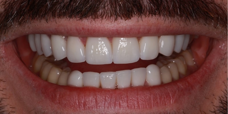 licówki stomatologiczne po