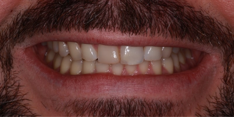 uzębienie pacjenta przed założeniem licówek stomatologicznych