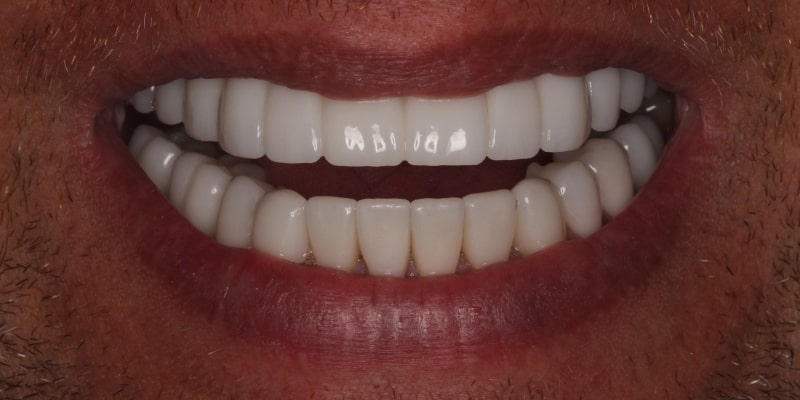 po uzupełnieniu braków w uzębieniu