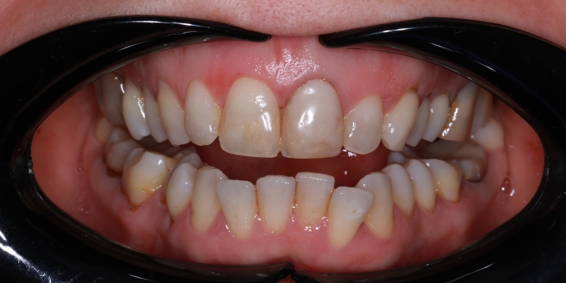 przed kompleksowym leczeniem stomatologicznym