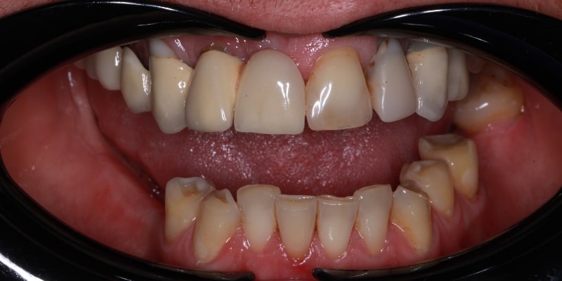 przed uzupełnieniem braków zębowych