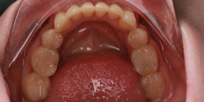 metamorfoza uśmiechu proste zęby po leczeniu nakładkami