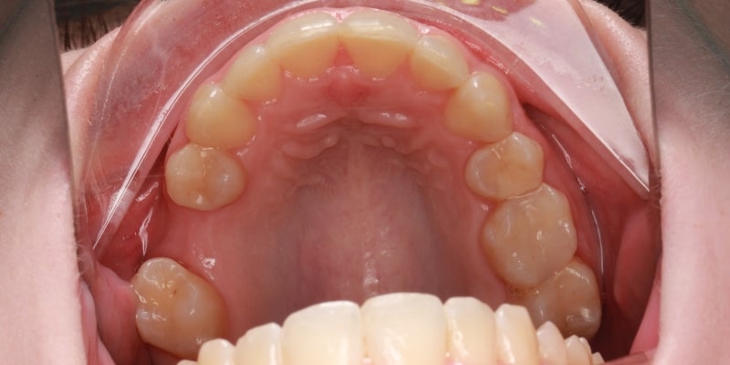metamorfoza uśmiechu stłoczone zęby przed leczeniem