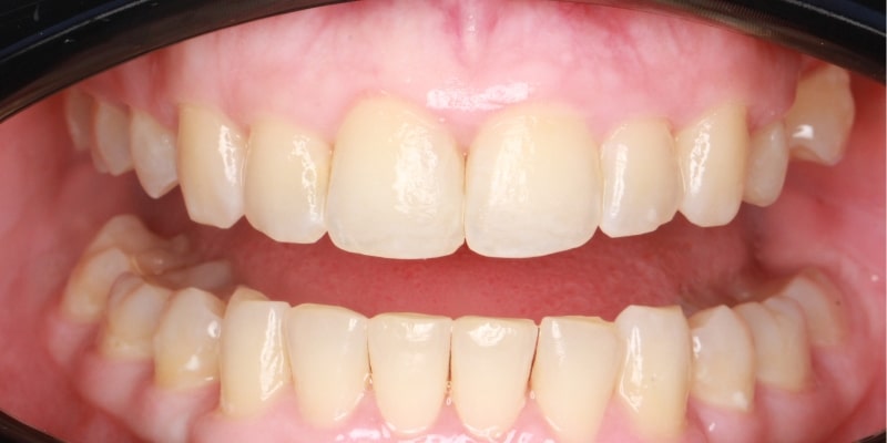 prostowanie zębów nakładkami efekt po leczeniu