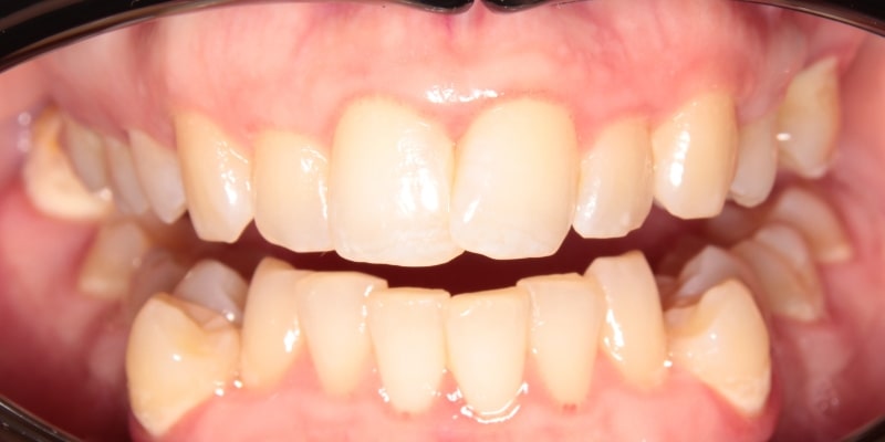 prostowanie zębów nakładkami przed leczeniem