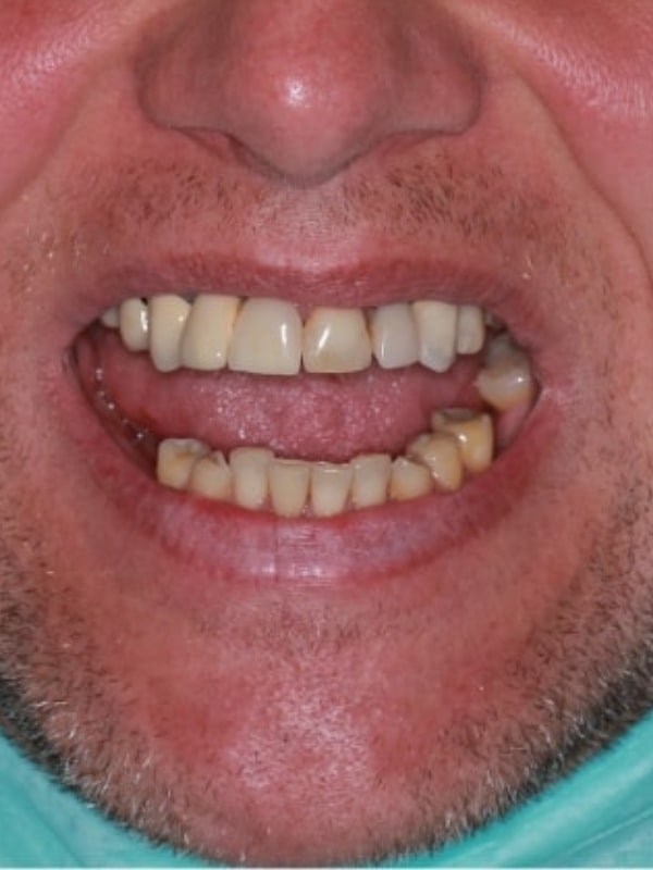 przed metamorfozą zębów z uzupełnieniem na implantach