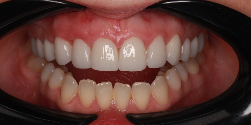 po metamorfozie koronami protetycznymi