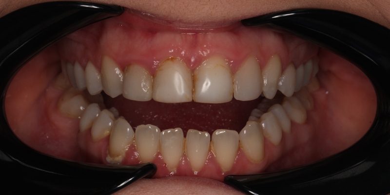 przed metamorfozą nieestetyczny bonding