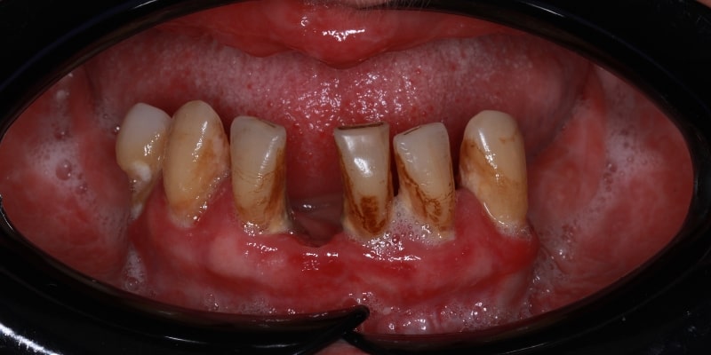 przed uzupełnieniem zębów mostem na implantach