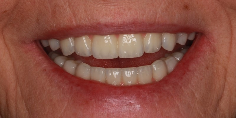 uzupełnienie zębów mostem po metamorfozie