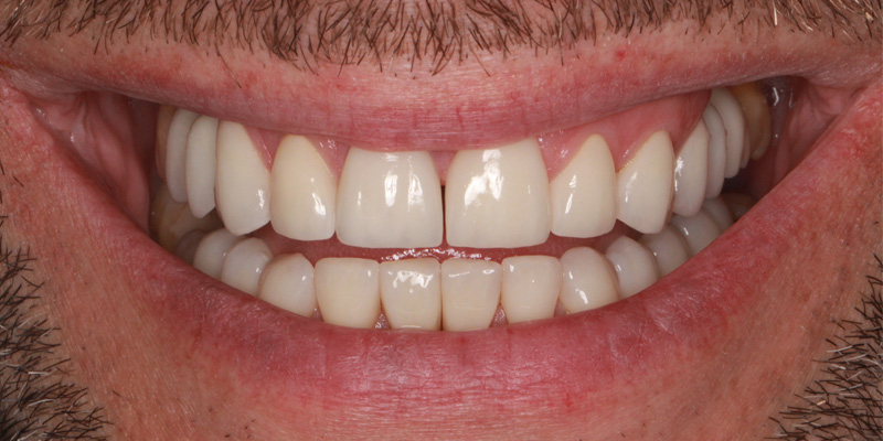 implantacja z odbudową kości