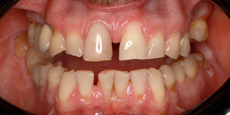 implantacja z odbudową kości