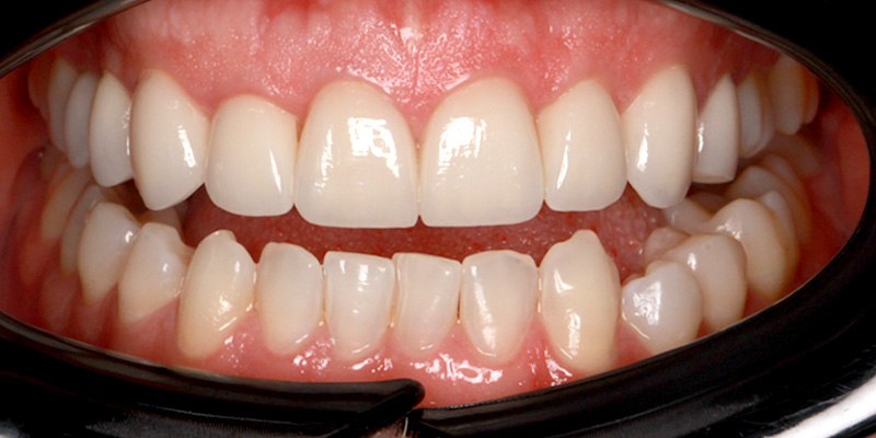 licówki na diastemę