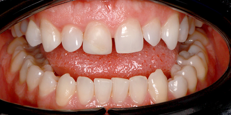 licówki na diastemę