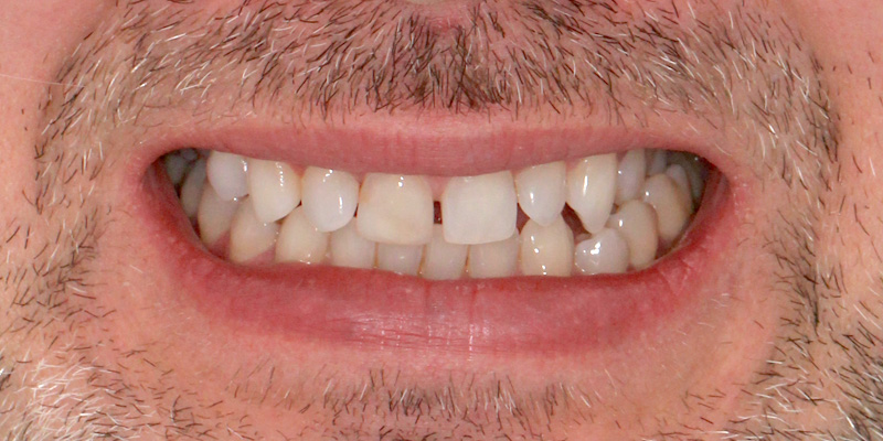 licówki na diastemę warszawa wola