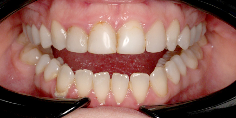 nieestetyczny bonding