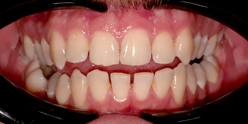 szpary między zębami