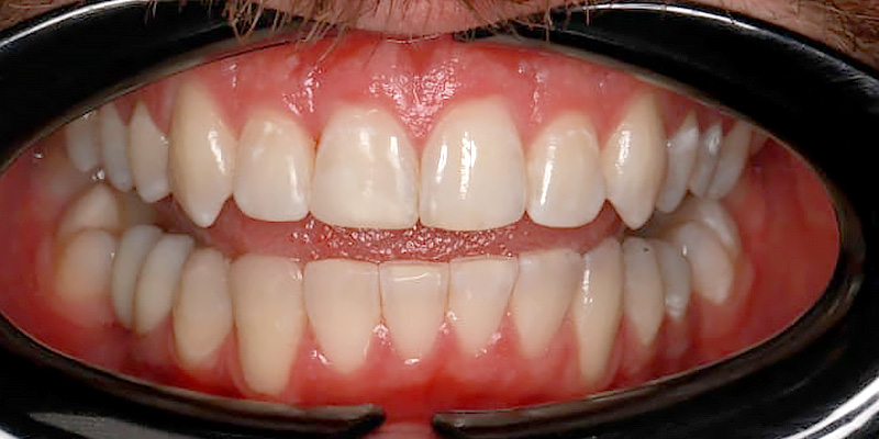 zamykanie szpary między zębami