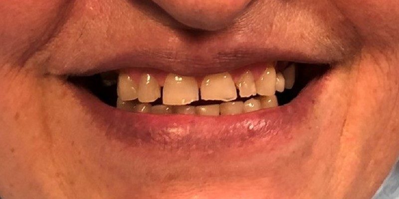 odbudowa zębów warszawa