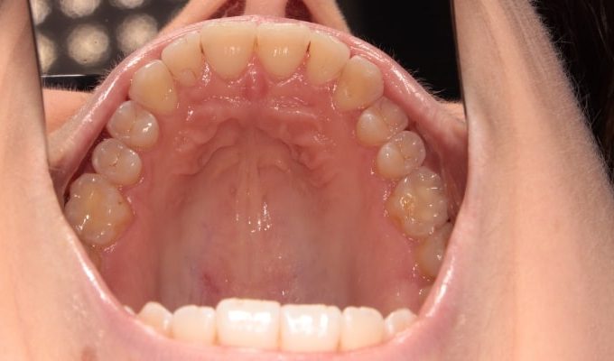 metamorfoza po leczeniu nakładkami