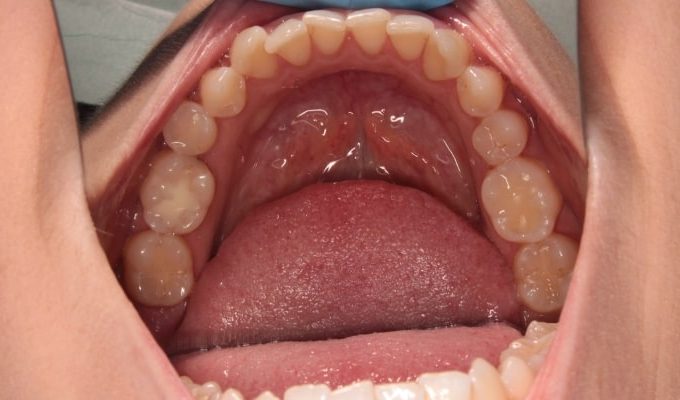 metamorfoza przed leczeniem nakładkami