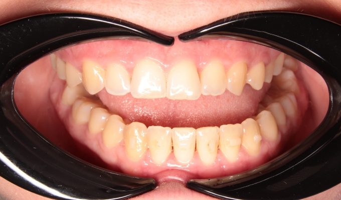 po leczeniu nakładkami ortodontycznymi