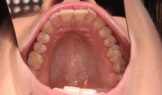 przed-leczeniem-nakladkami-na-zeby