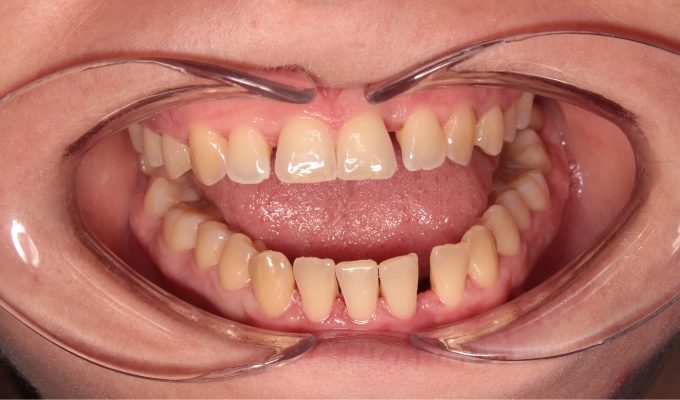 przed leczeniem nakładkami ortodontycznymi